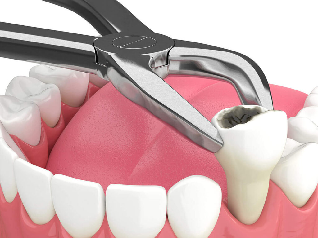 tooth extraction dental service
