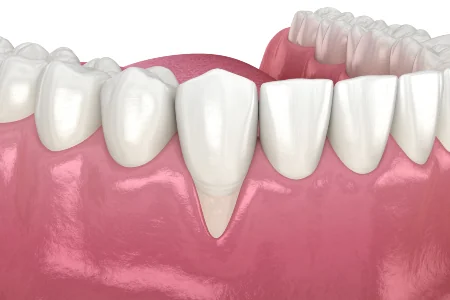 Gum Grafting services
